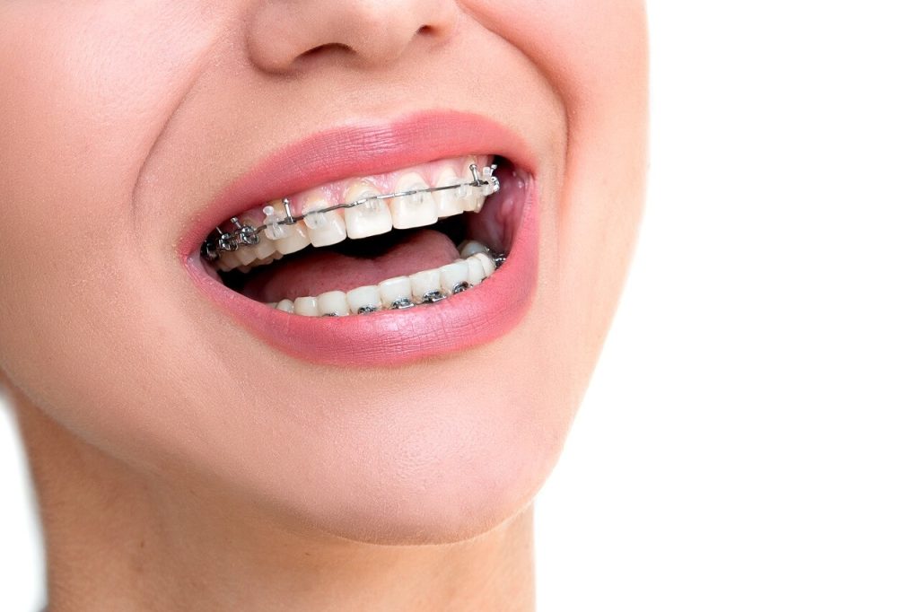 Braces cost Myrtle Beach
